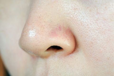 毛穴を攻めて守る！初夏のビタミンC毛穴ケア術